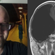 Tyler Leggett in August 2020 (left); the MRI scan of his brain that revealed the large cyst, taken in 2016 (right). Leggett’s doctors say the cyst has not changed in size since then.